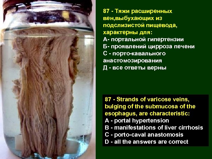 87 - Тяжи расширенных вен, выбухающих из подслизистой пищевода, характерны для: А- портальной гипертензии