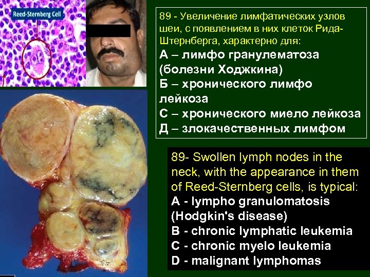 89 - Увеличение лимфатических узлов шеи, с появлением в них клеток Рида. Штернберга, характерно