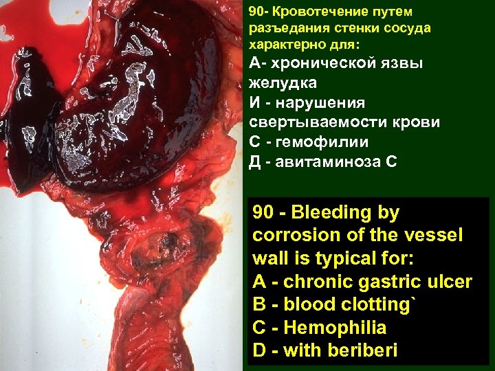 90 - Кровотечение путем разъедания стенки сосуда характерно для: А- хронической язвы желудка И