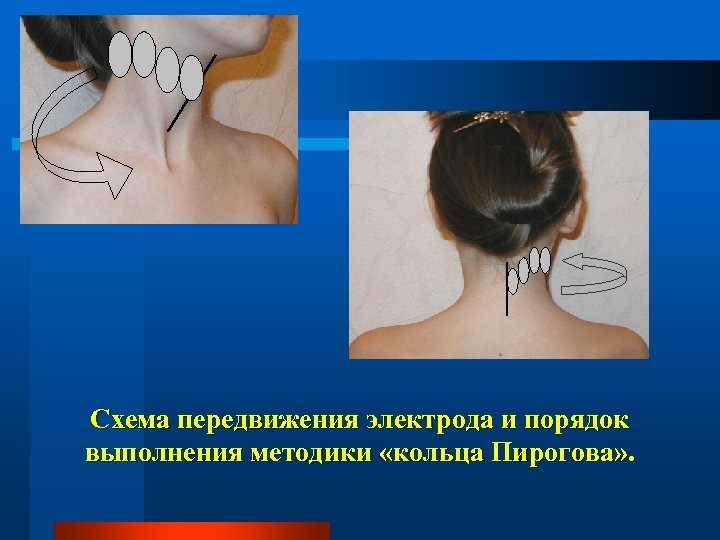 Схема передвижения электрода и порядок выполнения методики «кольца Пирогова» . 