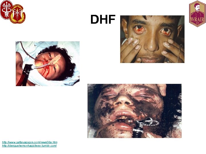 DHF http: //www. pattayagogos. com/news 08 a. htm http: //denguehemorrhagicfever. tumblr. com/ 