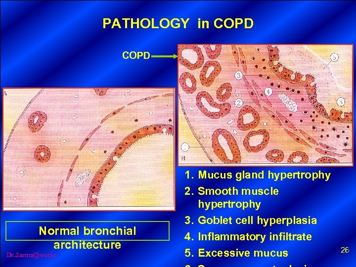 PATHOLOGY in COPD Normal bronchial architecture Dr. Sarma@works 1. Mucus gland hypertrophy 2. Smooth