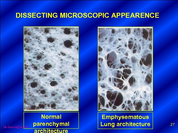 DISSECTING MICROSCOPIC APPEARENCE Dr. Sarma@works Normal parenchymal architecture Emphysematous Lung architecture 27 