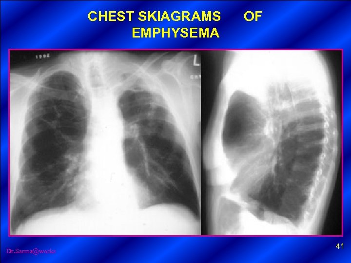 CHEST SKIAGRAMS OF EMPHYSEMA Dr. Sarma@works 41 