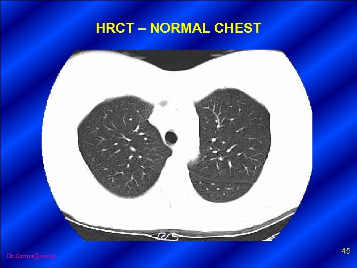 HRCT – NORMAL CHEST Dr. Sarma@works 45 