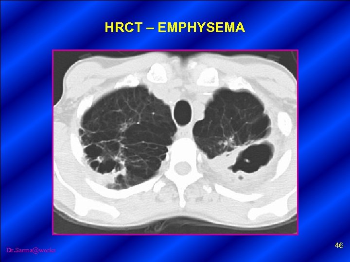 HRCT – EMPHYSEMA Dr. Sarma@works 46 