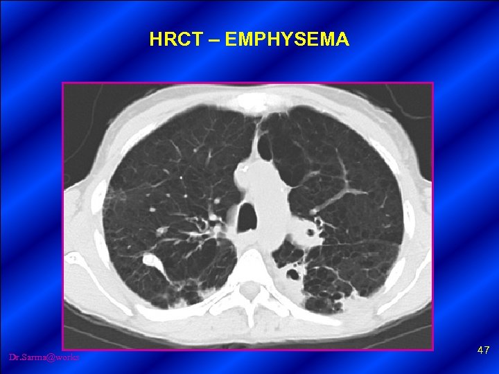 HRCT – EMPHYSEMA Dr. Sarma@works 47 