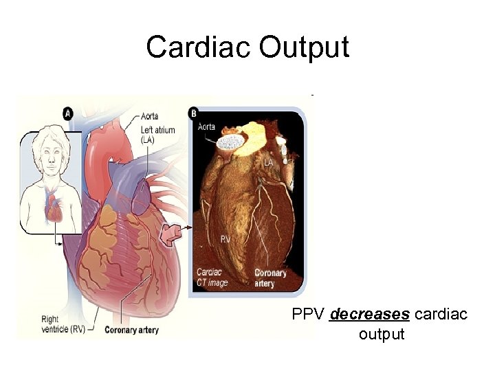 Cardiac Output • • • Sdfsf Asdfasdf Asdfsadfdf Asdfsadf PPV decreases cardiac output 