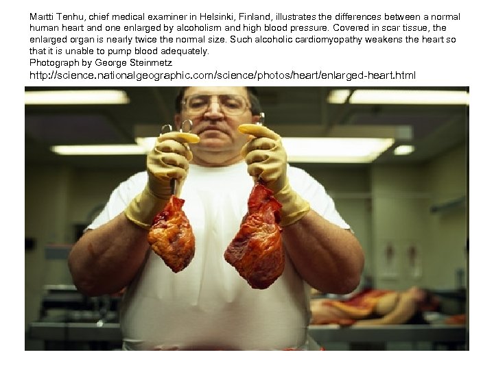 Martti Tenhu, chief medical examiner in Helsinki, Finland, illustrates the differences between a normal