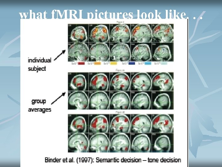what f. MRI pictures look like. . . 