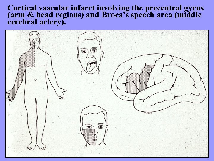 Cortical vascular infarct involving the precentral gyrus (arm & head regions) and Broca’s speech