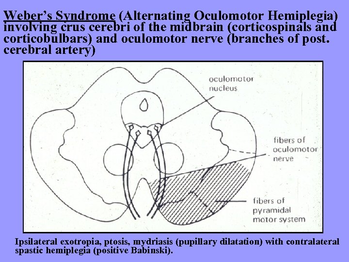 Weber’s Syndrome (Alternating Oculomotor Hemiplegia) involving crus cerebri of the midbrain (corticospinals and corticobulbars)