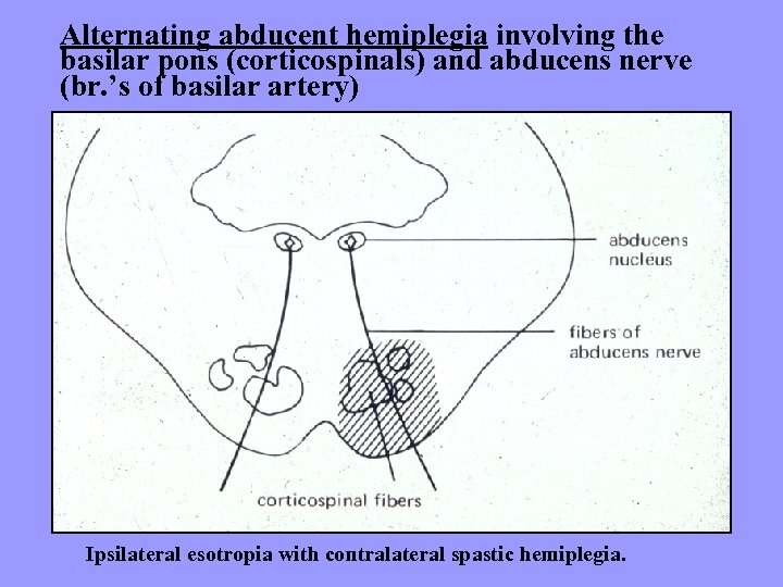 Alternating abducent hemiplegia involving the basilar pons (corticospinals) and abducens nerve (br. ’s of