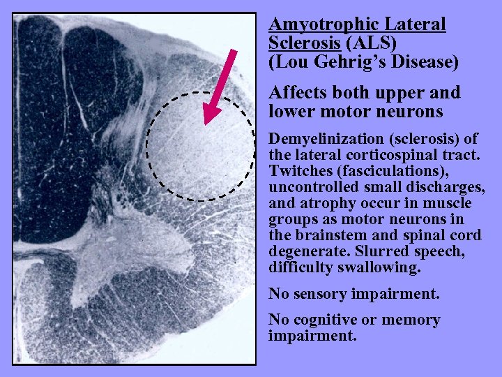 Amyotrophic Lateral Sclerosis (ALS) (Lou Gehrig’s Disease) Affects both upper and lower motor neurons