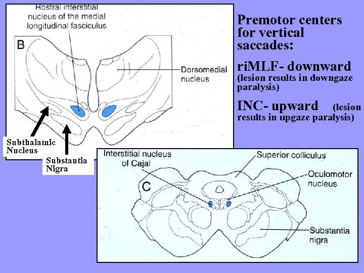 Premotor centers for vertical saccades: ri. MLF- downward (lesion results in downgaze paralysis) INC-