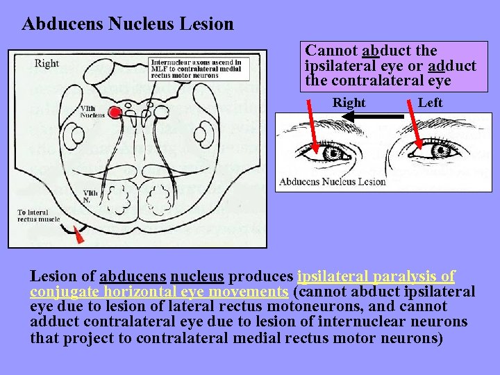 Abducens Nucleus Lesion Cannot abduct the ipsilateral eye or adduct the contralateral eye Right