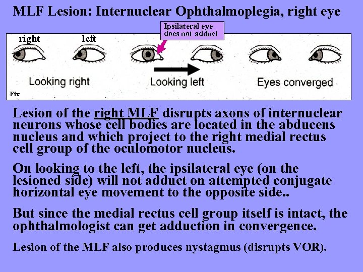 MLF Lesion: Internuclear Ophthalmoplegia, right eye right left Ipsilateral eye does not adduct Fix