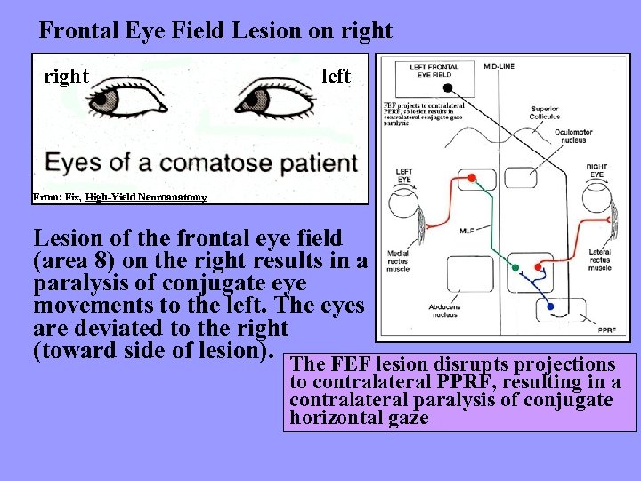 Frontal Eye Field Lesion on right left From: Fix, High-Yield Neuroanatomy Lesion of the