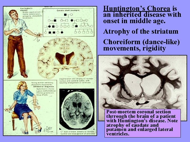 Huntington’s Chorea is an inherited disease with onset in middle age. Atrophy of the