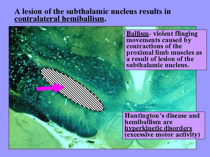 A lesion of the subthalamic nucleus results in contralateral hemiballism. Ballism- violent flinging movements