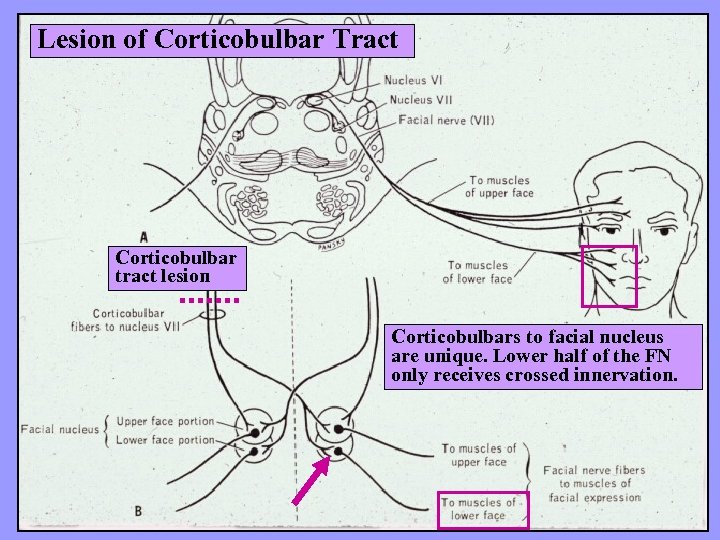 Lesion of Corticobulbar Tract Corticobulbar tract lesion Corticobulbars to facial nucleus are unique. Lower