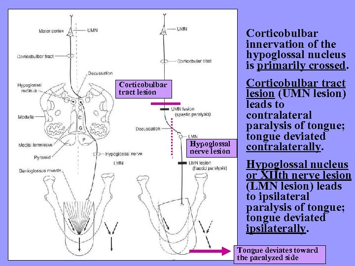 Corticobulbar tract lesion Hypoglossal nerve lesion Corticobulbar innervation of the hypoglossal nucleus is primarily