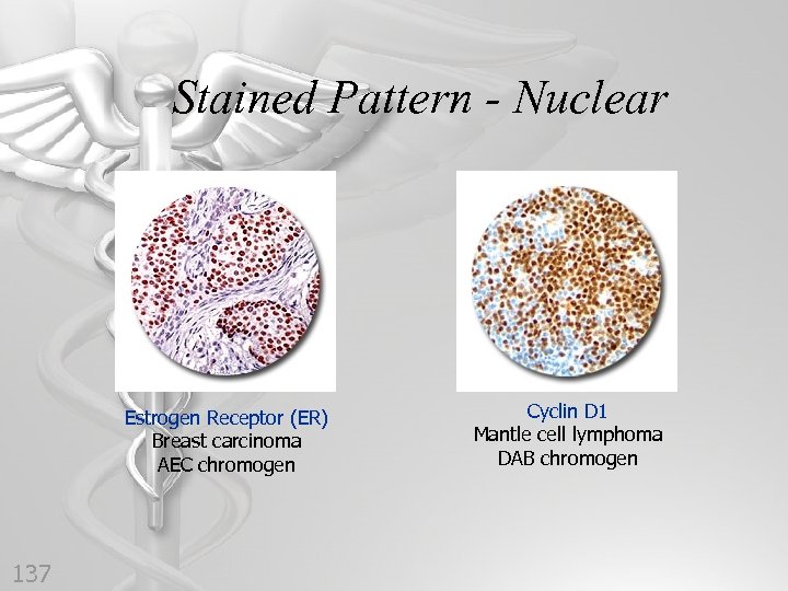 Stained Pattern - Nuclear Estrogen Receptor (ER) Breast carcinoma AEC chromogen 137 Cyclin D