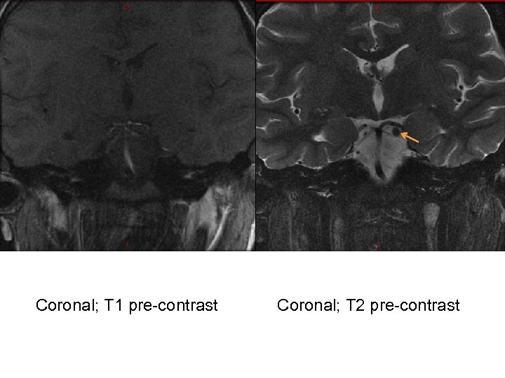 Coronal; T 1 pre-contrast Coronal; T 2 pre-contrast 