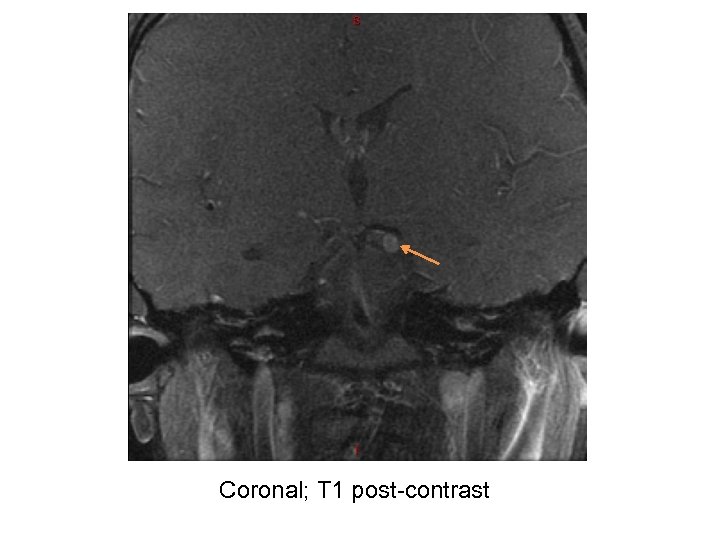 Coronal; T 1 post-contrast 