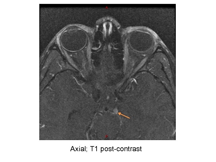 Axial; T 1 post-contrast 