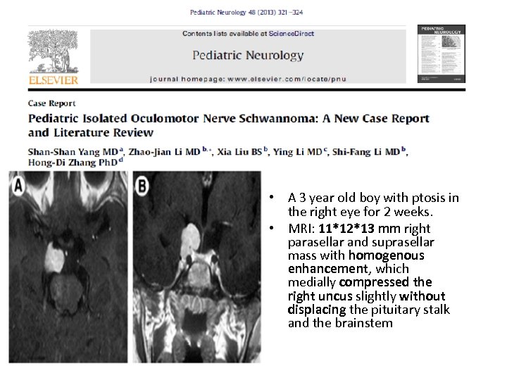  • A 3 year old boy with ptosis in the right eye for
