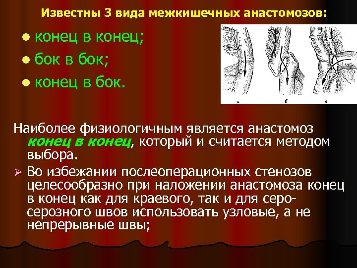 Известны 3 вида межкишечных анастомозов: l конец в конец; l бок в бок; l