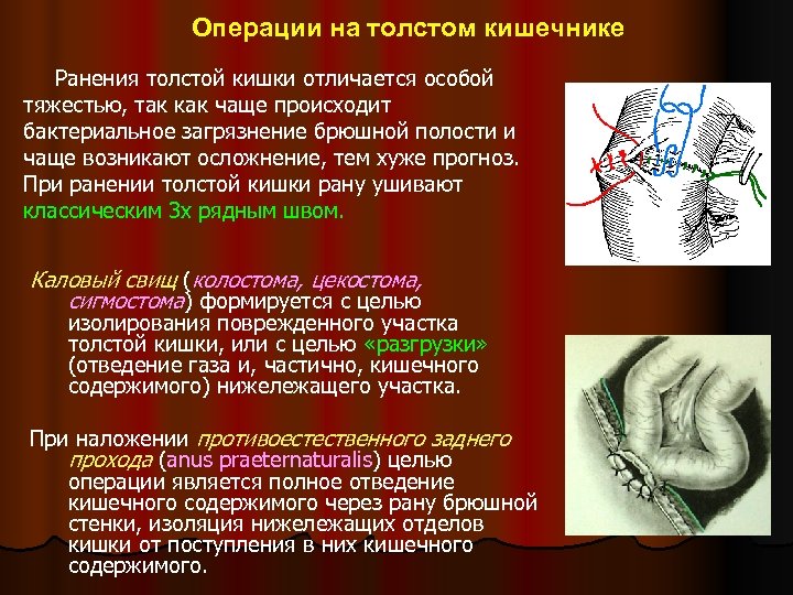 Операции на толстом кишечнике Ранения толстой кишки отличается особой тяжестью, так как чаще происходит