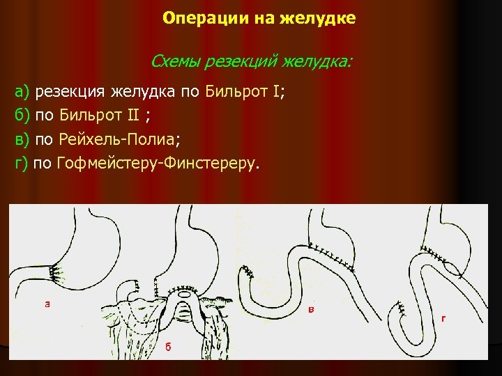 Операции по бильрот 1 и 2 схема