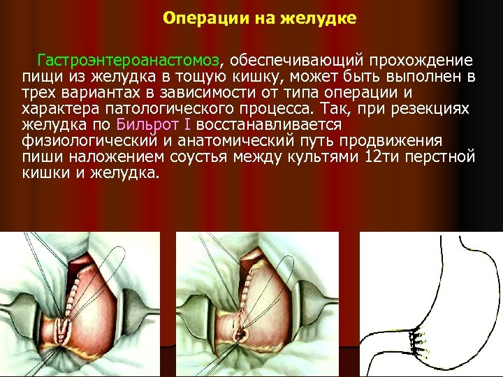Операции на желудке Гастроэнтероанастомоз, обеспечивающий прохождение пищи из желудка в тощую кишку, может быть
