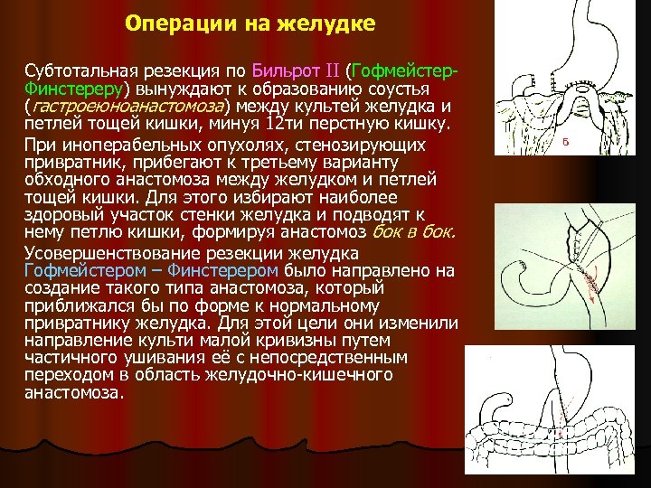 Операции на желудке Субтотальная резекция по Бильрот II (Гофмейстер. Финстереру) вынуждают к образованию соустья