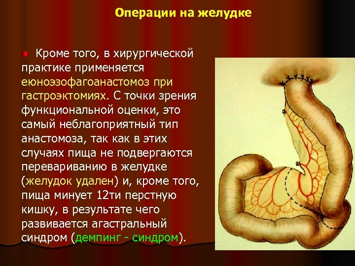 Операции на желудке Кроме того, в хирургической практике применяется еюноэзофагоанастомоз при гастроэктомиях. С точки