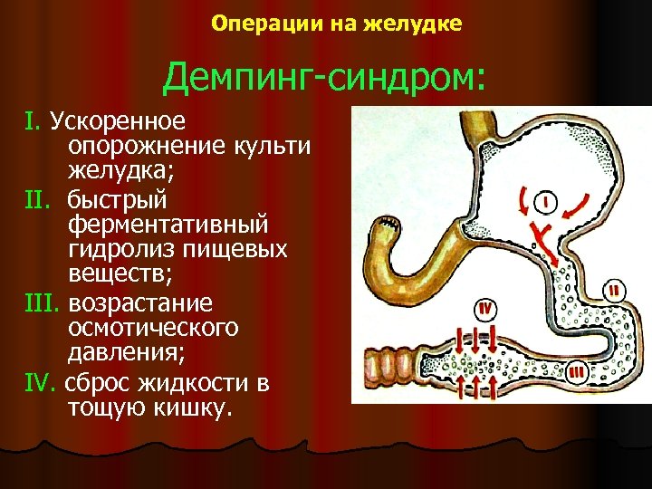 Операции на желудке Демпинг-синдром: I. Ускоренное опорожнение культи желудка; II. быстрый ферментативный гидролиз пищевых