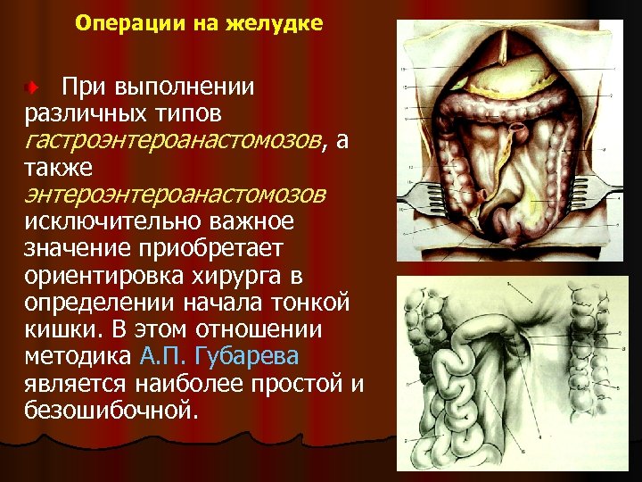 Операции на желудке При выполнении различных типов гастроэнтероанастомозов, а также энтероанастомозов исключительно важное значение