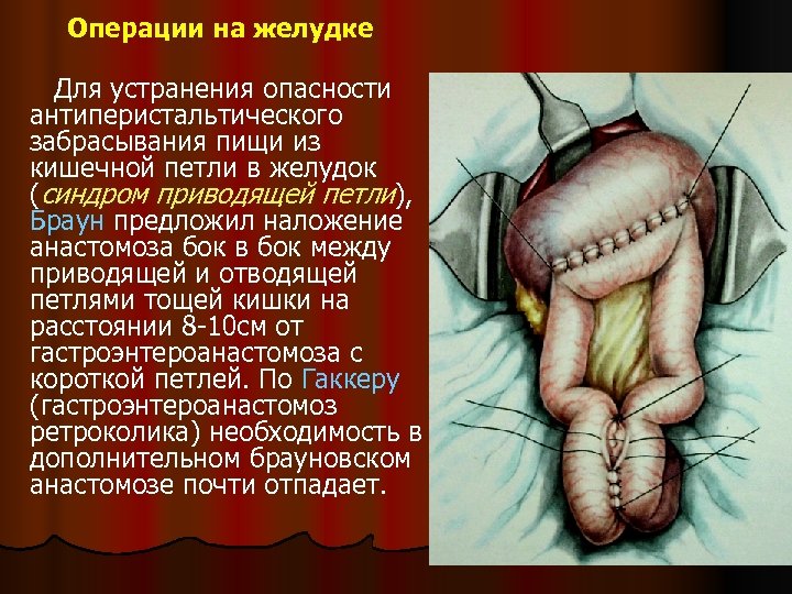 Операции на желудке Для устранения опасности антиперистальтического забрасывания пищи из кишечной петли в желудок