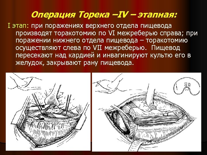Операция Торека –IV – этапная: I этап: при поражениях верхнего отдела пищевода производят торакотомию