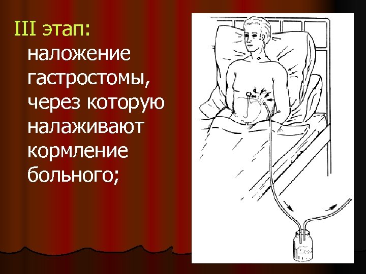 III этап: наложение гастростомы, через которую налаживают кормление больного; 