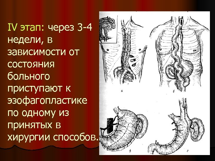 IV этап: через 3 -4 недели, в зависимости от состояния больного приступают к эзофагопластике