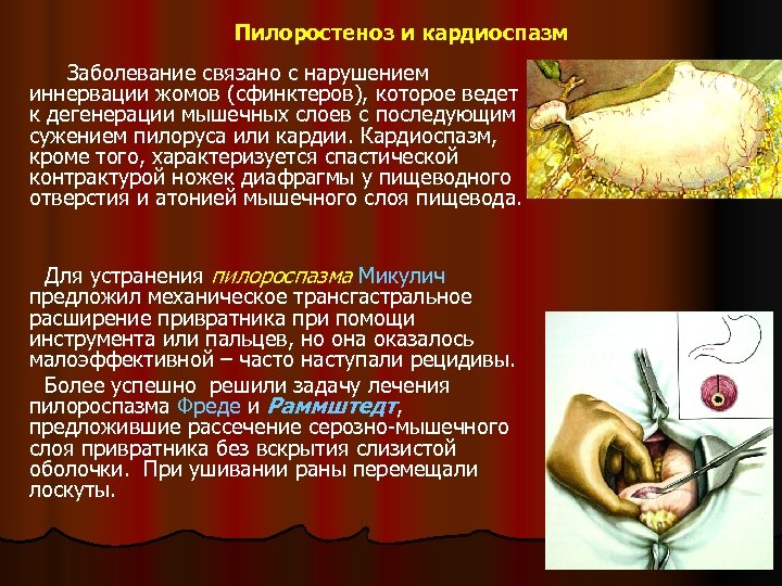 Пилоростеноз и кардиоспазм Заболевание связано с нарушением иннервации жомов (сфинктеров), которое ведет к дегенерации