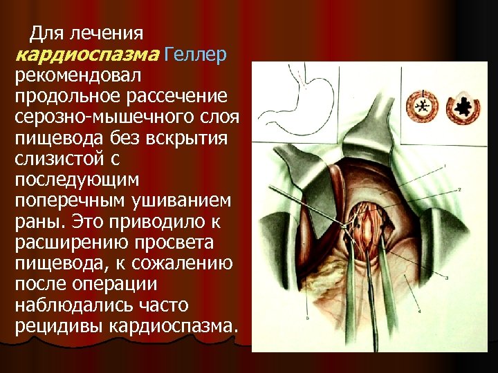 Для лечения кардиоспазма Геллер рекомендовал продольное рассечение серозно-мышечного слоя пищевода без вскрытия слизистой с
