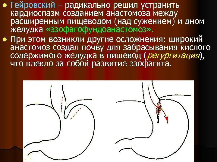 Гейровский – радикально решил устранить кардиоспазм созданием анастомоза между расширенным пищеводом (над сужением) и