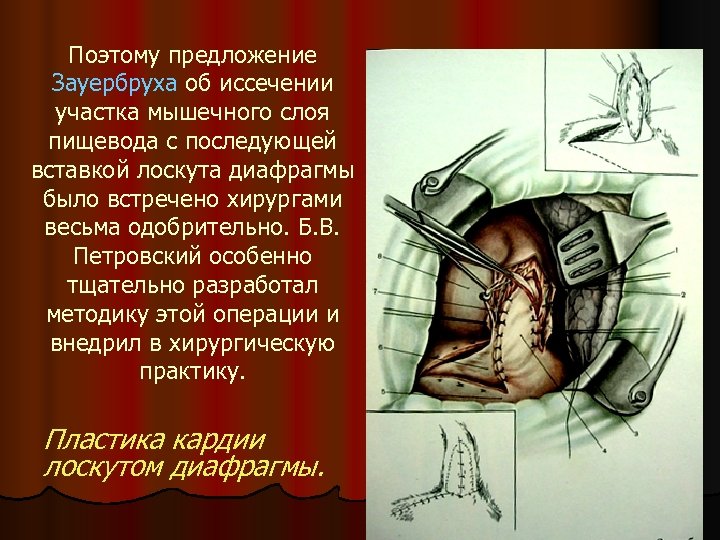 Поэтому предложение Зауербруха об иссечении участка мышечного слоя пищевода с последующей вставкой лоскута диафрагмы