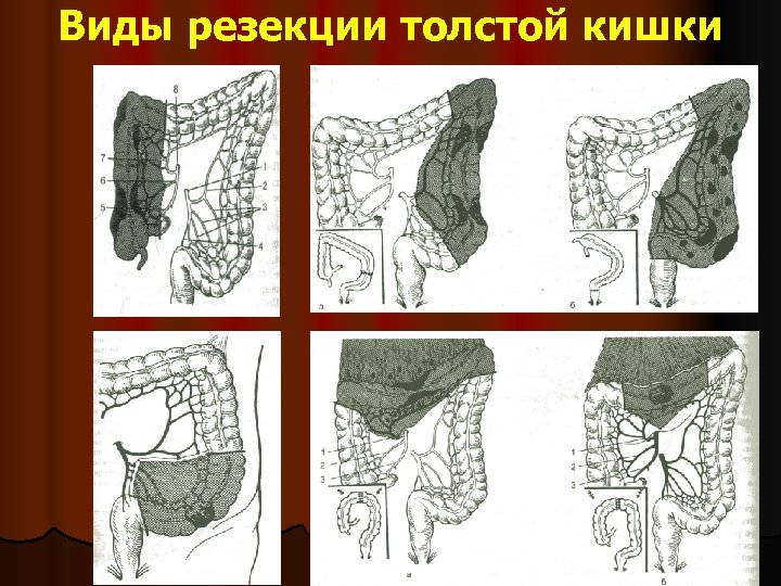 Операция лахея схема