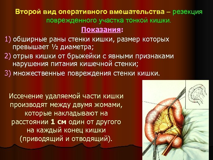 Второй вид оперативного вмешательства – резекция поврежденного участка тонкой кишки. Показания: 1) обширные раны