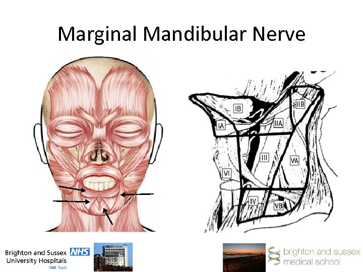 Marginal Mandibular Nerve 